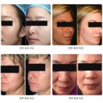 보레일라이 5D 베이비 페이스 인스트루먼트 이탈리안 브레라 골드 도트 리프팅 퍼밍 안티에이징 스킨 뷰티 살롱 인스트루먼트 - 이미지 4